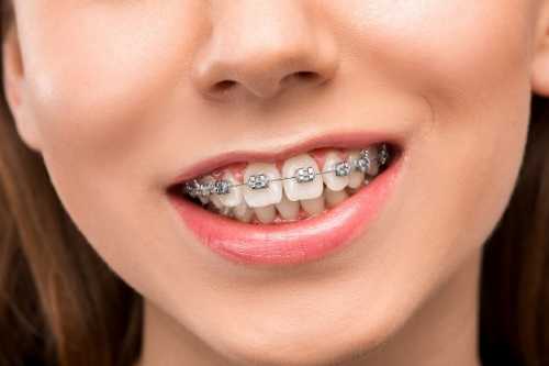 牙縫增大是潔牙引起的嗎？