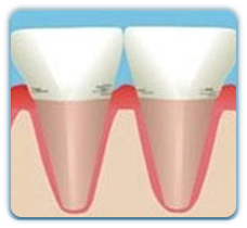 深圳牙齦炎治療醫生