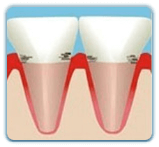 香港牙根刮治價錢