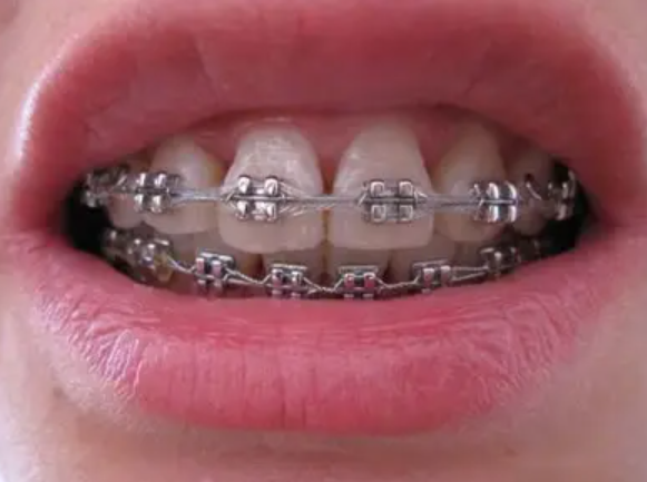 牙齒矯正有沒有副作用？