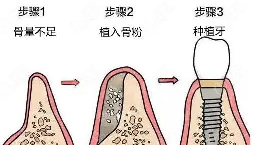 我想種植牙，牙槽骨骨量不足怎麽辦？