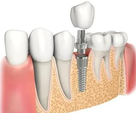 想做種植牙得先了解這些問題
