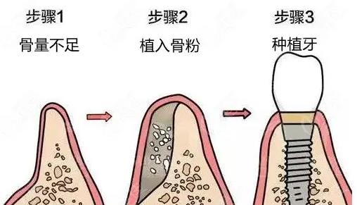 種植牙的過程大概有這幾個步驟