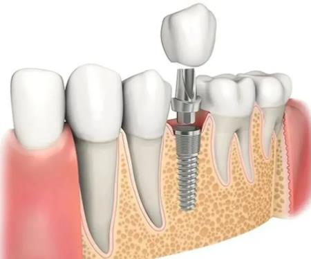 怎麽減輕種植牙的術後腫脹？