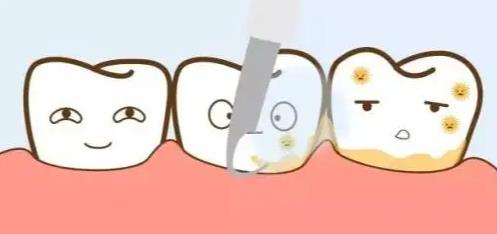牙周刮治對牙齒有傷害嗎？牙周刮治是什麼意思？