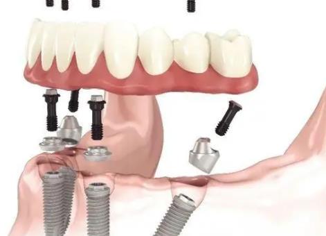 全口種植牙的禁忌症有哪些？