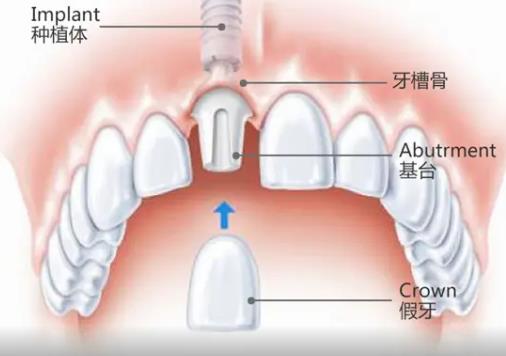 種植的牙齒出現了牙結石還能洗牙嗎？會不會掉？