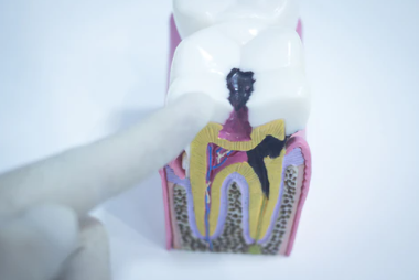 牙疼後爲什麽醫生建議你根管治療而不是補牙