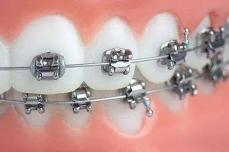 珠海澳門箍牙：為什麼箍牙的價格差別很大？