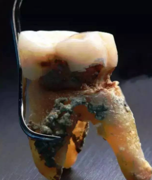 牙醫給自然脫落的牙齒拍微距照片！萬萬沒想到！