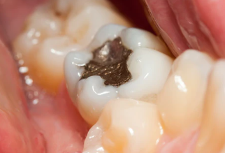 補牙不做冠，療效少一半！根管治療後牙齒已經不疼了，爲什麽還要戴牙冠呢？