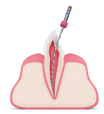 爲什麽有時牙齒表面只有一個小洞，卻需要根管治療？