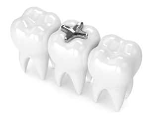 牙齒敏感如何改善？