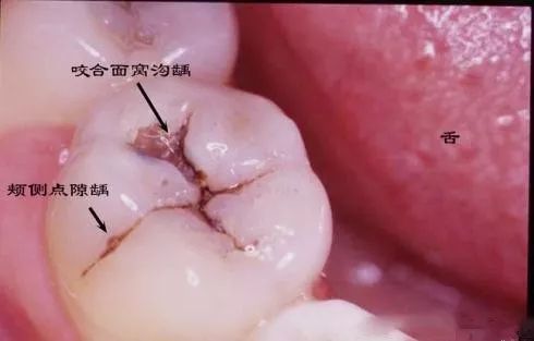 快啲睇下你個齒有冇黑線？當後齒出現黑線牙齒已經「亮起紅燈」！