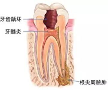 各種類型牙痛嘅用藥技巧