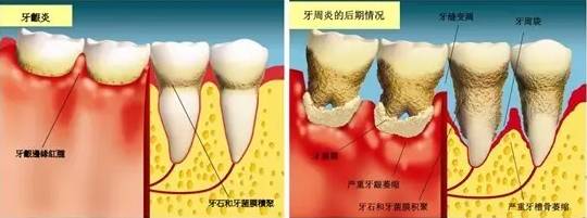 牙周炎十大病征，你中咗幾招？