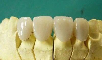 點解醫生要磨兩邊牙齒先鑲一顆牙？