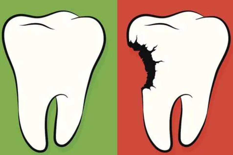 多年唔洗牙，牙石淤積成鍾乳石！係時候放下對洗牙嘅偏見嘞！