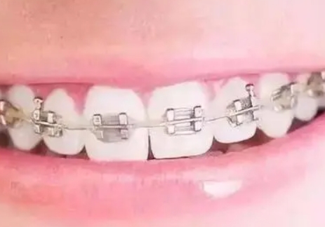 牙齒矯正嘅時間能縮短嗎？
