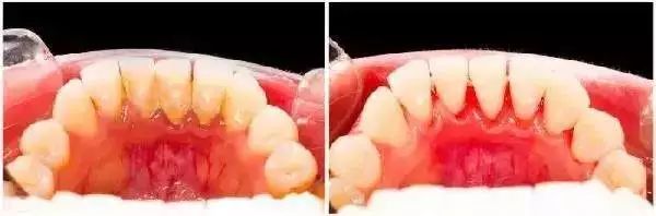 點解你會有洗牙後牙結石會長的更快d嘅錯覺呢？