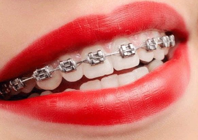 網上隨便買個“隱形牙套”自己矯正，呢嘅係自我“毀牙”！！！