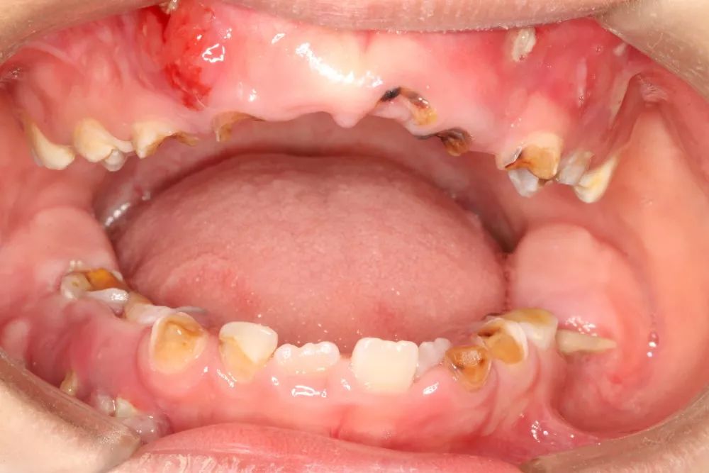 乳牙壞咗唔使理？未及時治療，4歲男童一口牙幾乎爛光