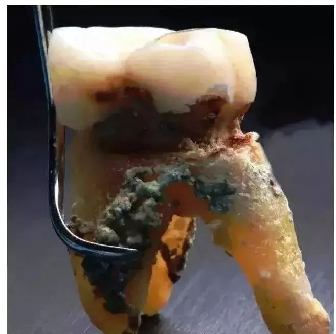 多年不洗牙，牙結石堆成鐘乳石！是時候放下對洗牙的偏見了！