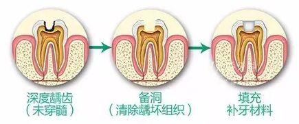 補牙後牙痛，正常嗎