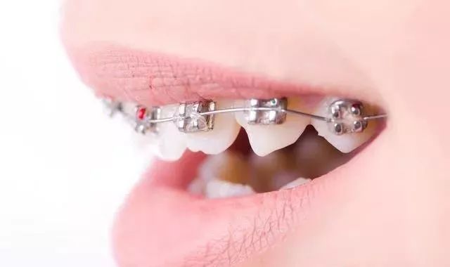 成年了能進行牙齒矯正嗎？瞭解4件事，牙齒矯正冇年齡限制