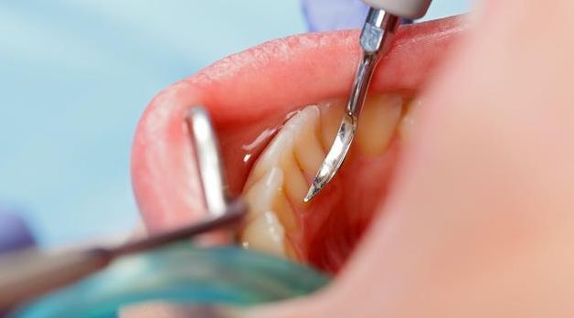 牙結石會影響健康嗎？點樣預防牙結石