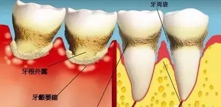 定期洗牙，係你省錢嘅開始！