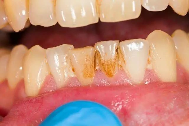牙齒上嘅牙菌斑總是反覆，一定係嘅刷牙方式出咗問題