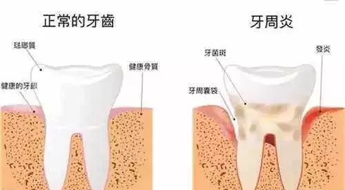 血糖高，您可能需要警惕牙周病