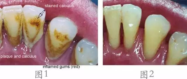 點解都係洗牙，價格卻唔一樣？瞭解一下呢4種洗牙技術