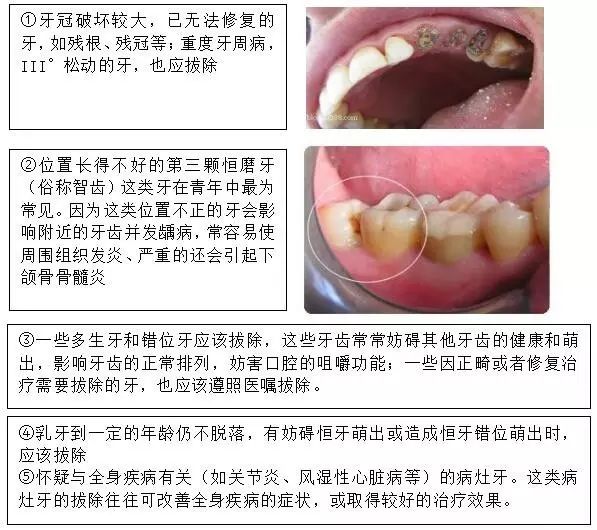 點樣的牙需要拔？牙齒摔斷咗又該點算？