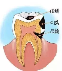 補牙，點解唔可以一次完成？