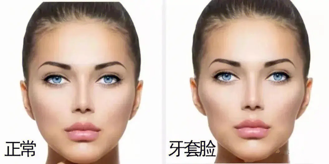 牙套臉是暫時嘅定係永久存在嘅呢？