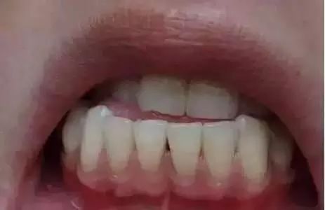 年紀輕輕，點解也會牙齦萎縮呢-