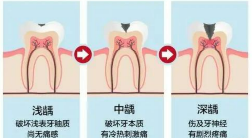 澳門補牙價錢點解會咁貴？補牙性價比推薦！