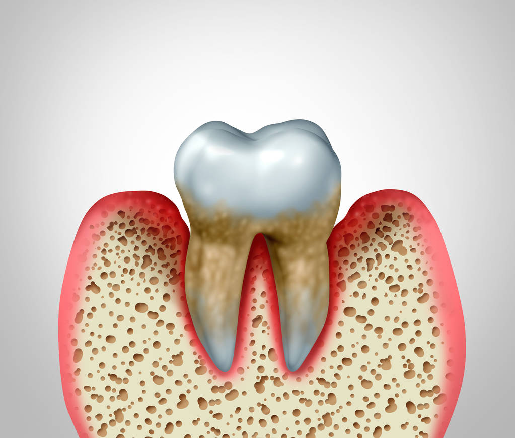 牙齦上長膿包，擠掉后還是反覆長，怎麼回事？