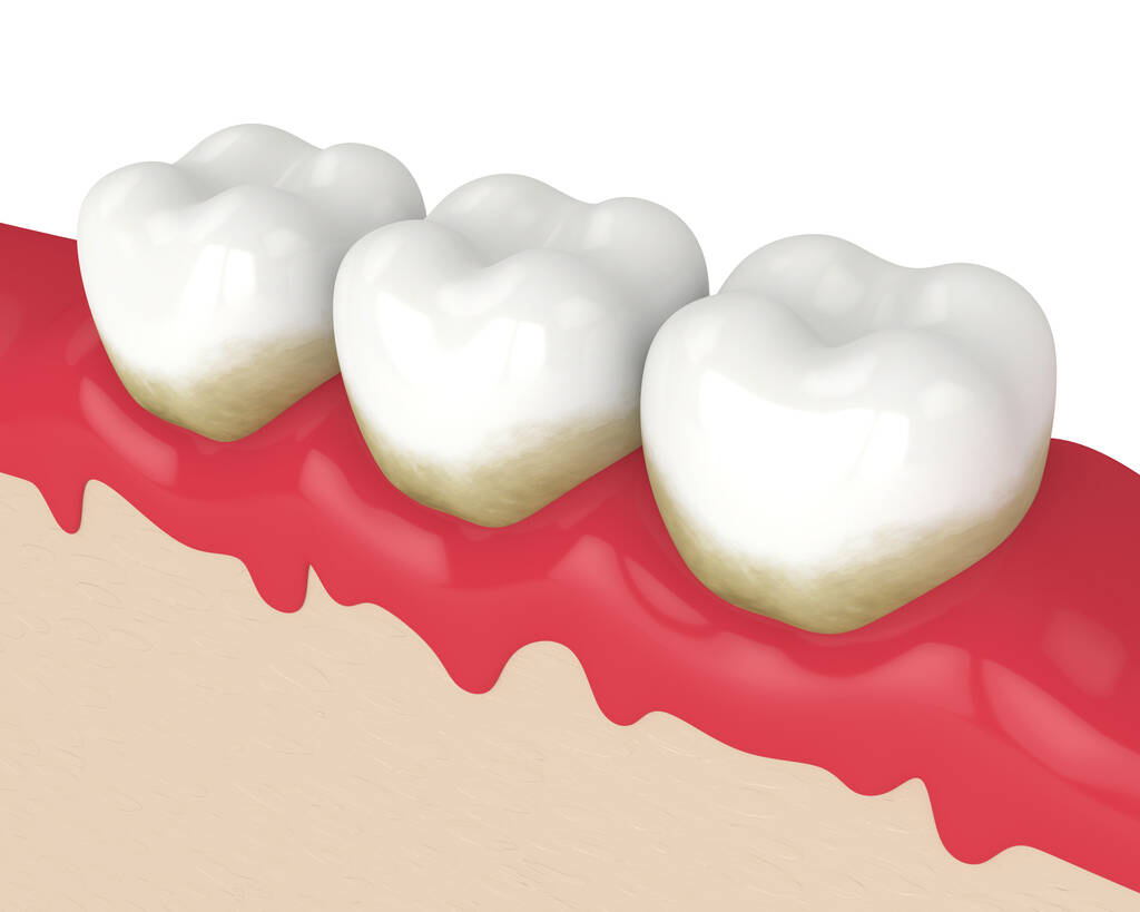 為什麼你的牙齦會經常出血？