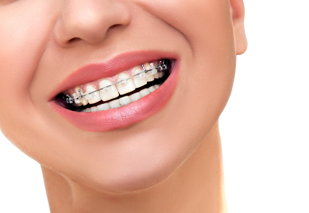 為什麼越來越多的人做牙齒矯正？