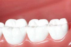 四環素牙應該如何進行美白？
