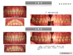 澳門張小姐嘴凸矯正案例分析