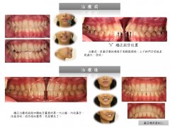 澳門李小姐嘴凸矯正案例