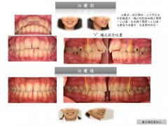 澳門歐陽小姐嘴凸矯正案例