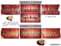 澳門文小姐嘴凸矯正案例