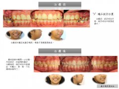 澳門小昊嘴凸矯正案例分析