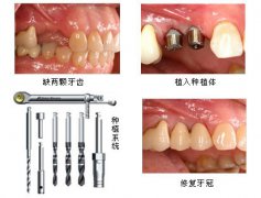 澳門翁小姐種植釘支抗治療中線嚴重偏斜伴前牙