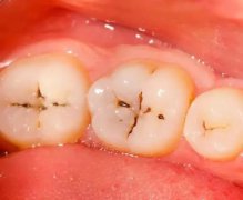 你的牙齒上有小黑點嗎？